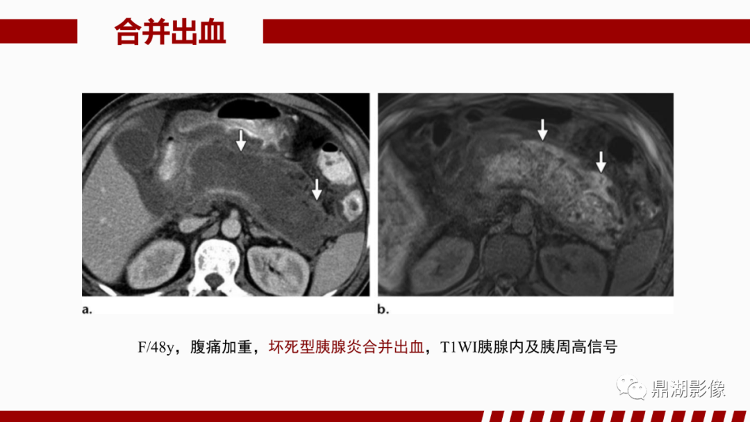 影像PPT - 【PPT】基于修订版亚特兰大急性胰腺炎分类的诊断、临床影像评估及治疗-53