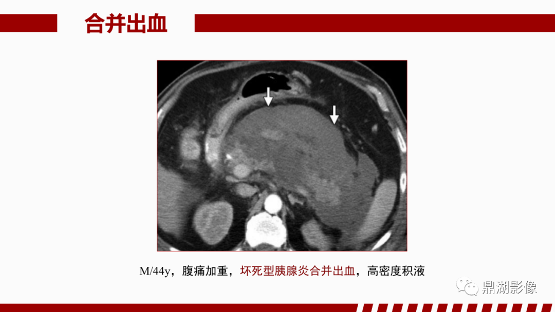 影像PPT - 【PPT】基于修订版亚特兰大急性胰腺炎分类的诊断、临床影像评估及治疗-54
