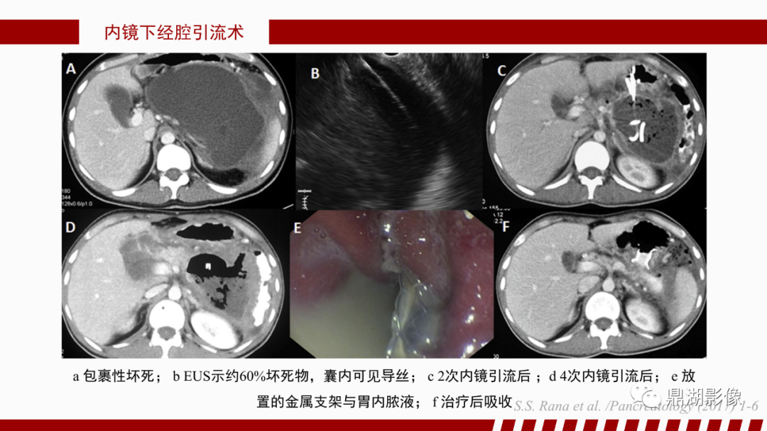 影像PPT - 【PPT】基于修订版亚特兰大急性胰腺炎分类的诊断、临床影像评估及治疗-62
