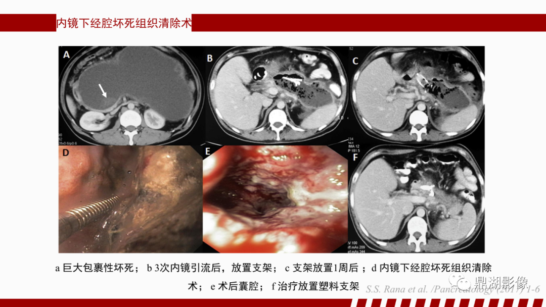 影像PPT - 【PPT】基于修订版亚特兰大急性胰腺炎分类的诊断、临床影像评估及治疗-63
