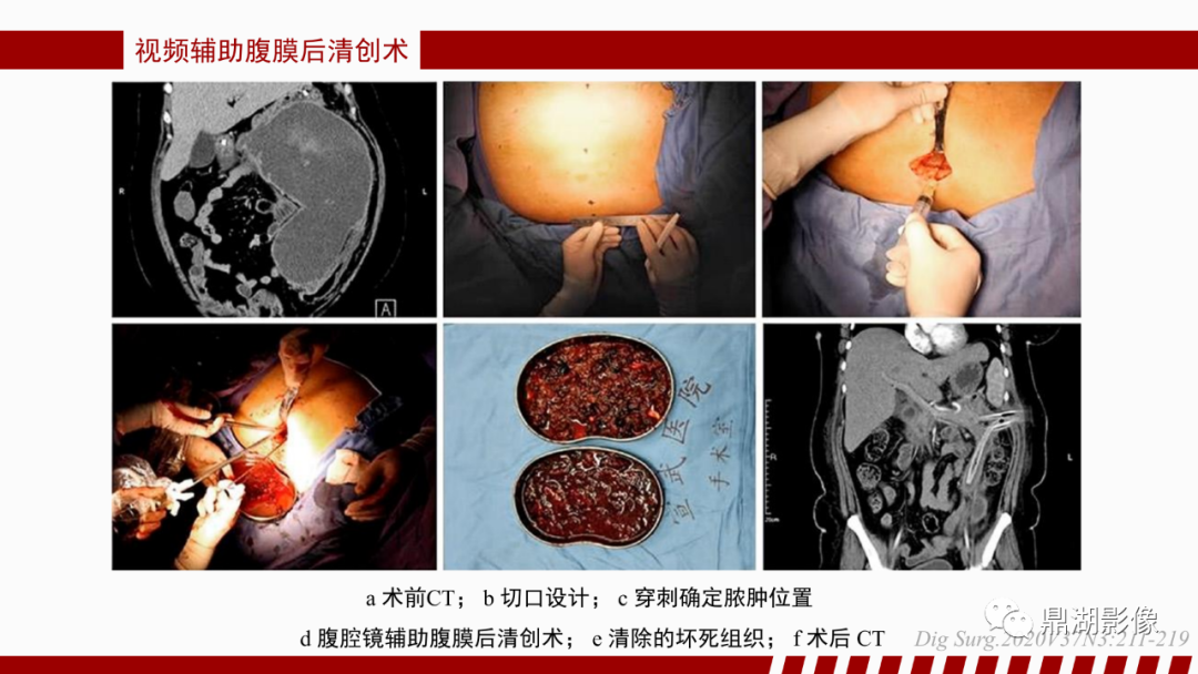 影像PPT - 【PPT】基于修订版亚特兰大急性胰腺炎分类的诊断、临床影像评估及治疗-65
