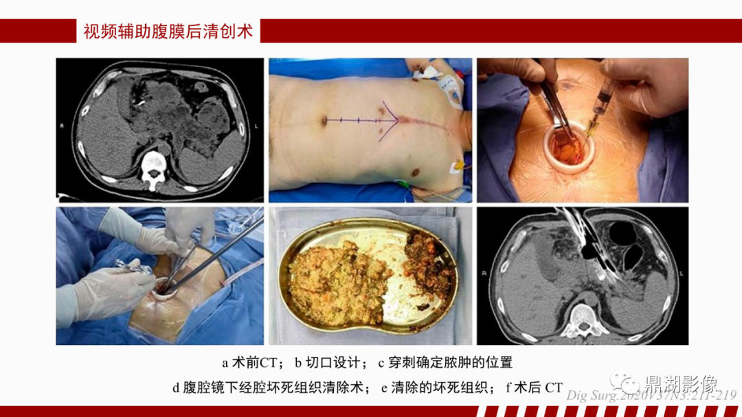 影像PPT - 【PPT】基于修订版亚特兰大急性胰腺炎分类的诊断、临床影像评估及治疗-64