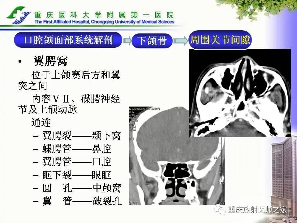 影像PPT - 【PPT】下颌骨解剖及相关疾病影像诊断-9