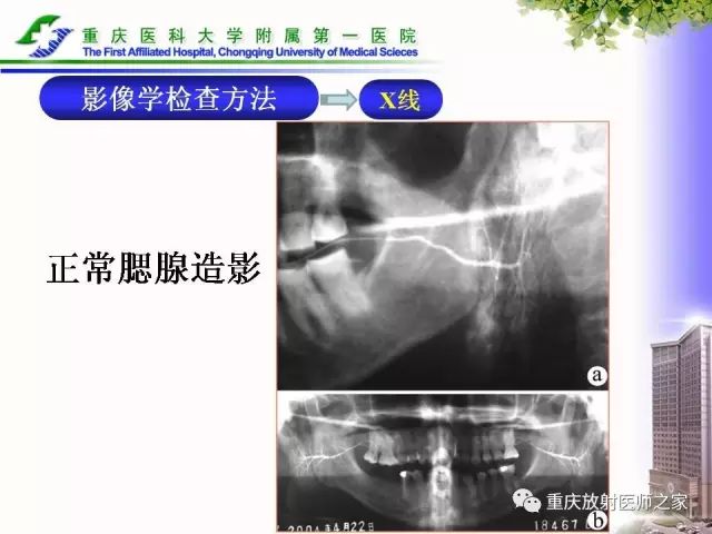 影像PPT - 【PPT】下颌骨解剖及相关疾病影像诊断-23