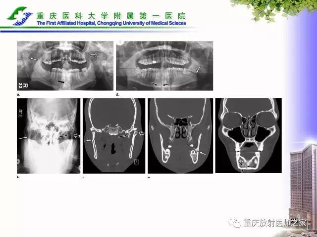 影像PPT - 【PPT】下颌骨解剖及相关疾病影像诊断-25