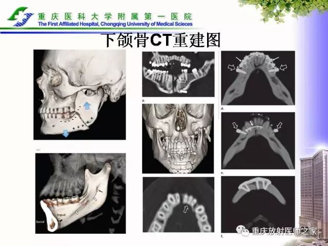 影像PPT - 【PPT】下颌骨解剖及相关疾病影像诊断-26
