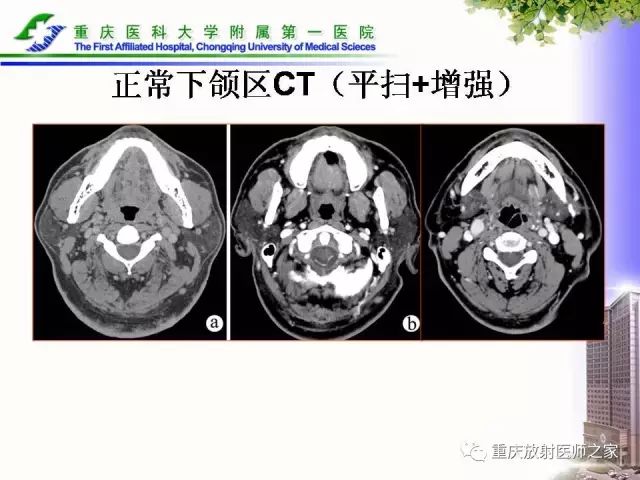 影像PPT - 【PPT】下颌骨解剖及相关疾病影像诊断-27