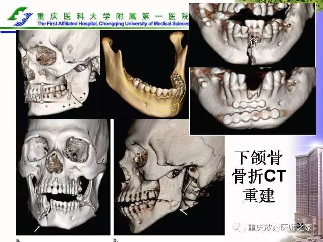 影像PPT - 【PPT】下颌骨解剖及相关疾病影像诊断-34