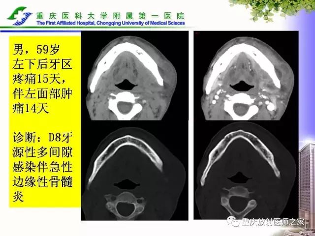影像PPT - 【PPT】下颌骨解剖及相关疾病影像诊断-37