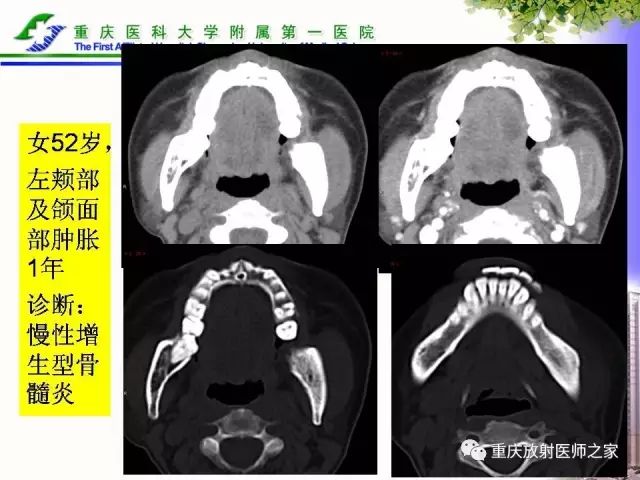 影像PPT - 【PPT】下颌骨解剖及相关疾病影像诊断-39