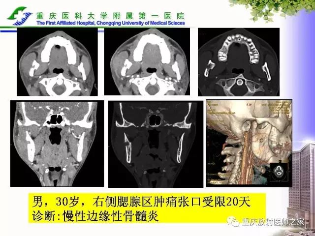 影像PPT - 【PPT】下颌骨解剖及相关疾病影像诊断-38