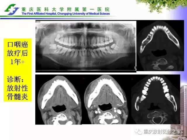 影像PPT - 【PPT】下颌骨解剖及相关疾病影像诊断-40