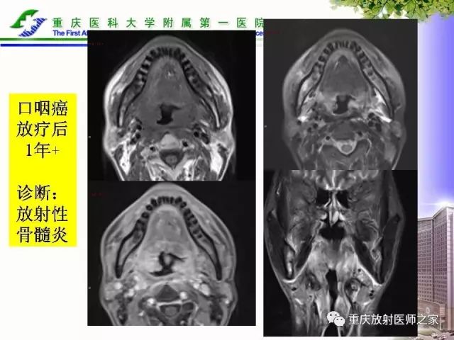 影像PPT - 【PPT】下颌骨解剖及相关疾病影像诊断-41