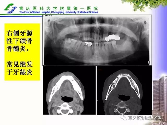 影像PPT - 【PPT】下颌骨解剖及相关疾病影像诊断-36