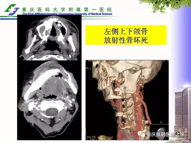 影像PPT - 【PPT】下颌骨解剖及相关疾病影像诊断-42