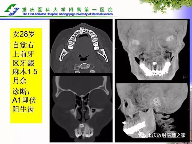 影像PPT - 【PPT】下颌骨解剖及相关疾病影像诊断-44