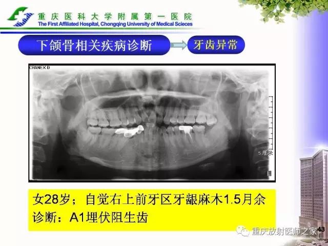 影像PPT - 【PPT】下颌骨解剖及相关疾病影像诊断-43