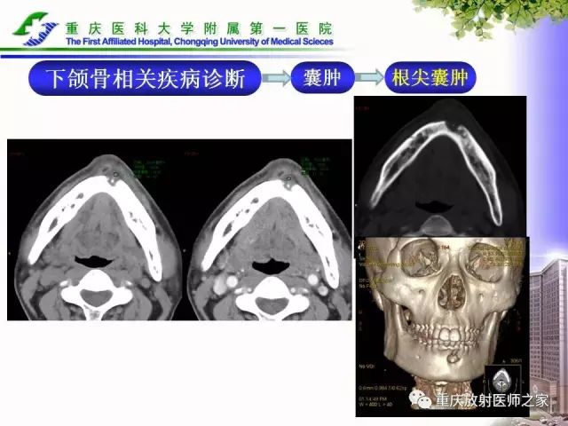 影像PPT - 【PPT】下颌骨解剖及相关疾病影像诊断-51