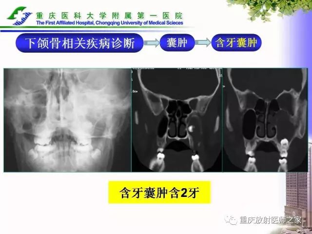 影像PPT - 【PPT】下颌骨解剖及相关疾病影像诊断-53