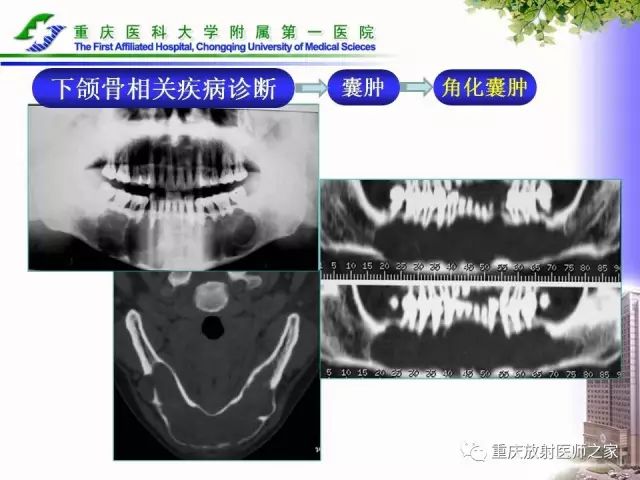 影像PPT - 【PPT】下颌骨解剖及相关疾病影像诊断-55