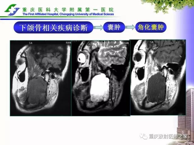 影像PPT - 【PPT】下颌骨解剖及相关疾病影像诊断-56