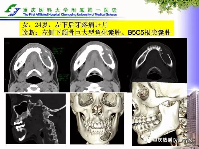 影像PPT - 【PPT】下颌骨解剖及相关疾病影像诊断-57