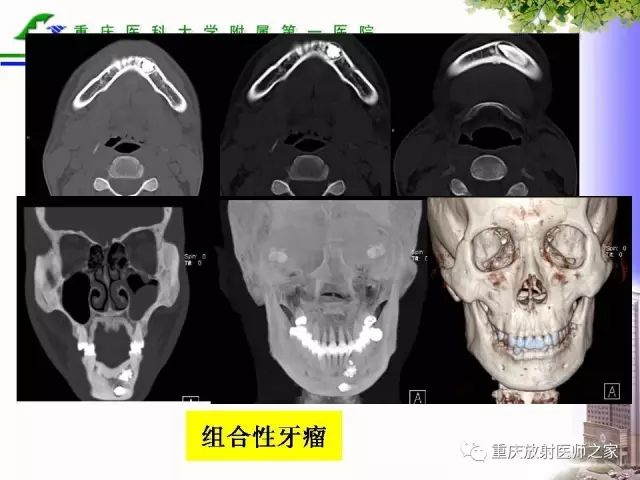 影像PPT - 【PPT】下颌骨解剖及相关疾病影像诊断-61