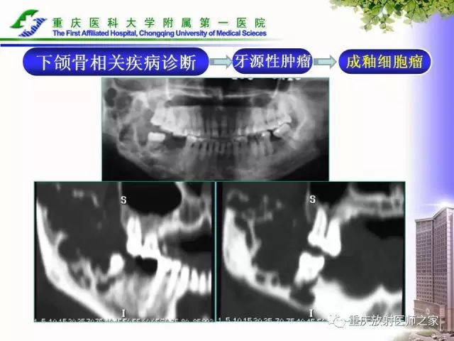 影像PPT - 【PPT】下颌骨解剖及相关疾病影像诊断-65