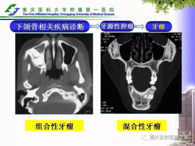 影像PPT - 【PPT】下颌骨解剖及相关疾病影像诊断-60