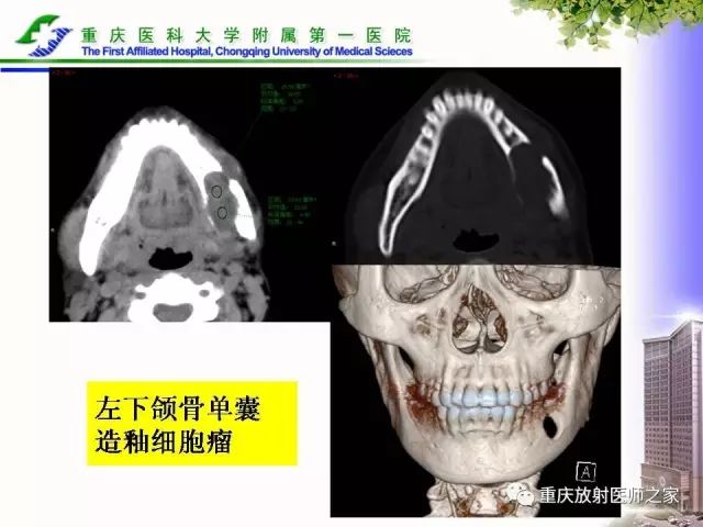 影像PPT - 【PPT】下颌骨解剖及相关疾病影像诊断-66