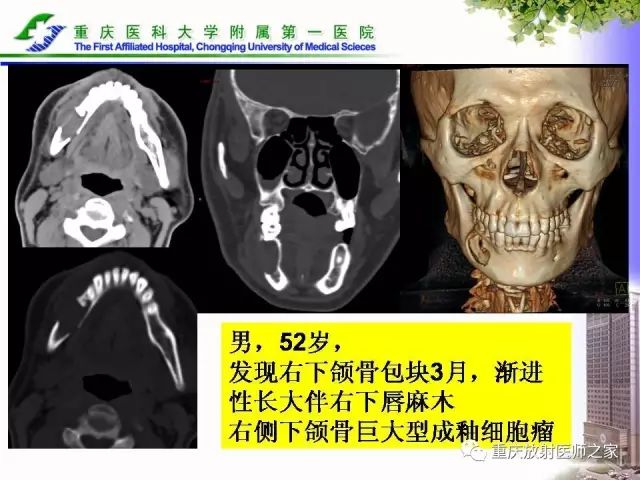 影像PPT - 【PPT】下颌骨解剖及相关疾病影像诊断-67