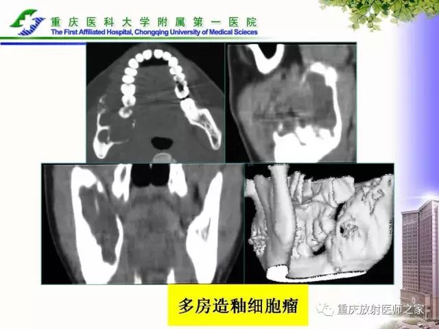 影像PPT - 【PPT】下颌骨解剖及相关疾病影像诊断-68