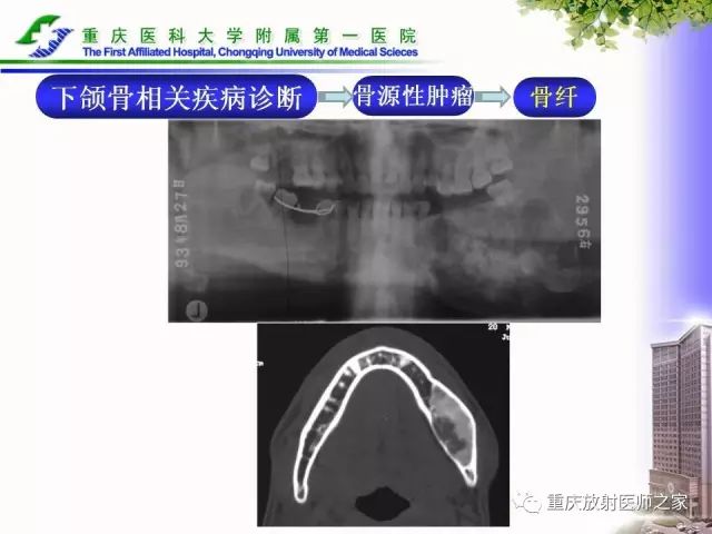 影像PPT - 【PPT】下颌骨解剖及相关疾病影像诊断-72