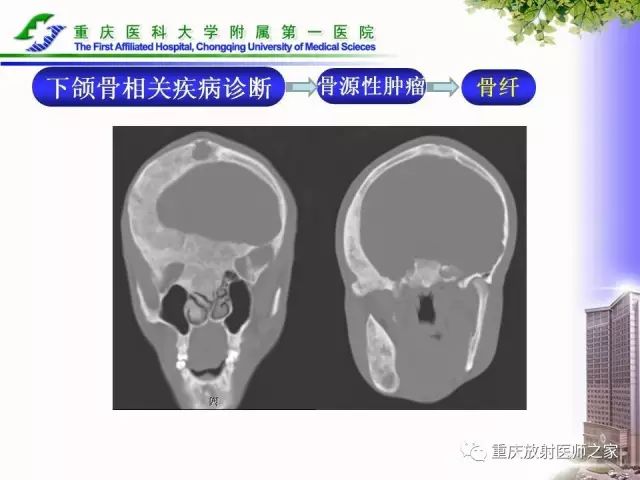 影像PPT - 【PPT】下颌骨解剖及相关疾病影像诊断-73