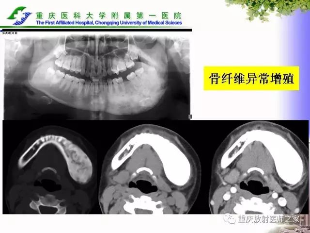 影像PPT - 【PPT】下颌骨解剖及相关疾病影像诊断-74