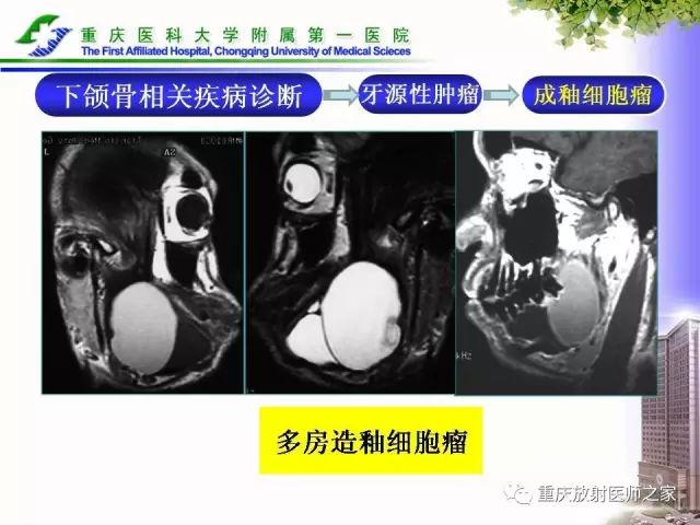 影像PPT - 【PPT】下颌骨解剖及相关疾病影像诊断-69