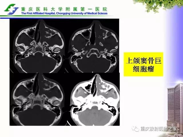 影像PPT - 【PPT】下颌骨解剖及相关疾病影像诊断-76