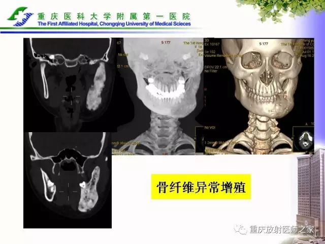 影像PPT - 【PPT】下颌骨解剖及相关疾病影像诊断-75