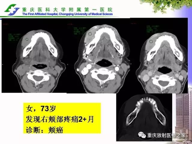 影像PPT - 【PPT】下颌骨解剖及相关疾病影像诊断-82