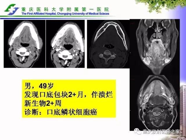 影像PPT - 【PPT】下颌骨解剖及相关疾病影像诊断-83