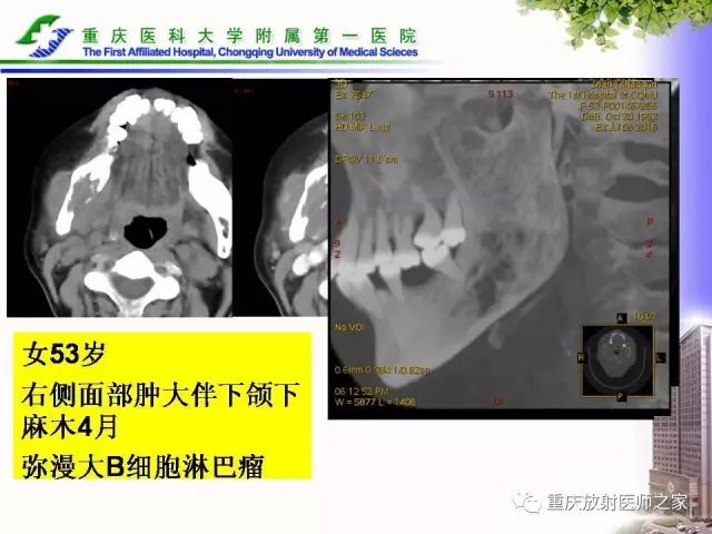 影像PPT - 【PPT】下颌骨解剖及相关疾病影像诊断-84