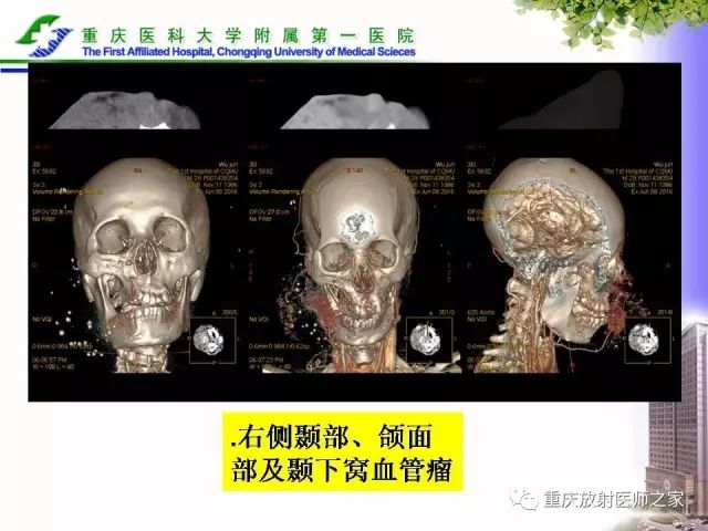 影像PPT - 【PPT】下颌骨解剖及相关疾病影像诊断-85
