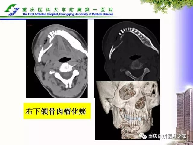 影像PPT - 【PPT】下颌骨解剖及相关疾病影像诊断-86