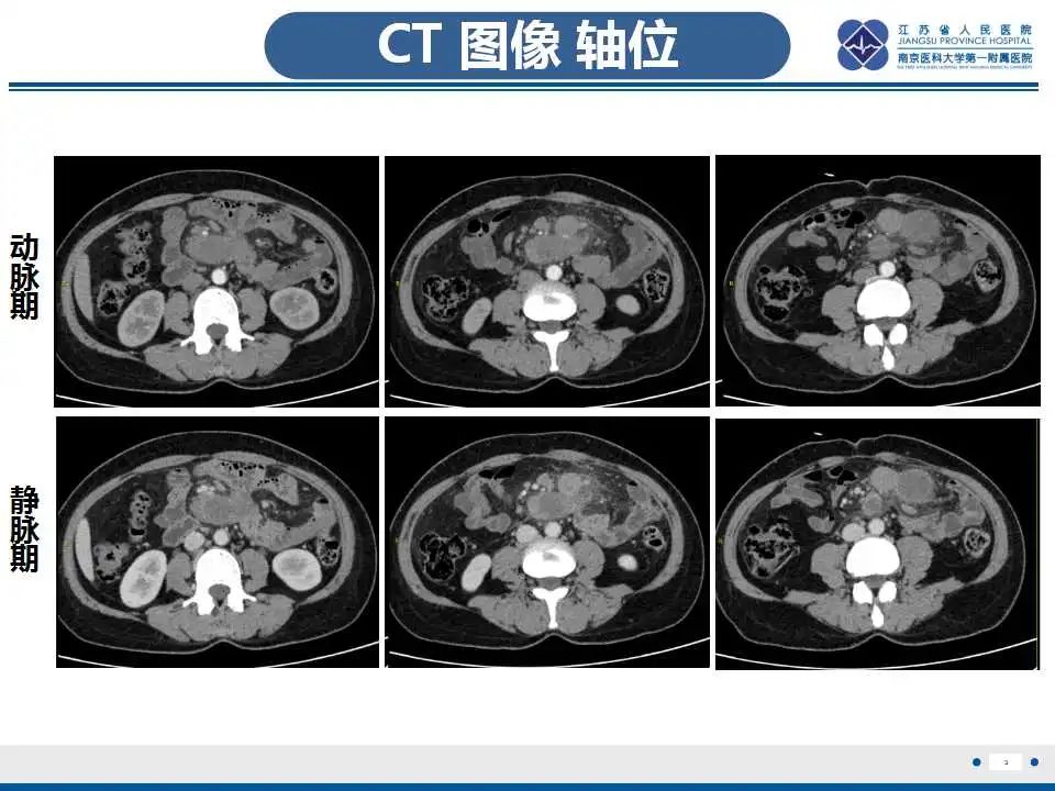 影像PPT - 【PPT】腹腔里的“三明治”—肠系膜淋巴瘤-4