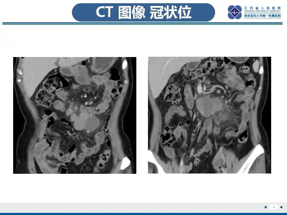 影像PPT - 【PPT】腹腔里的“三明治”—肠系膜淋巴瘤-6