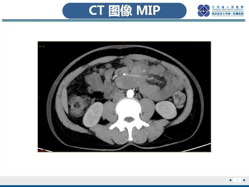 影像PPT - 【PPT】腹腔里的“三明治”—肠系膜淋巴瘤-7
