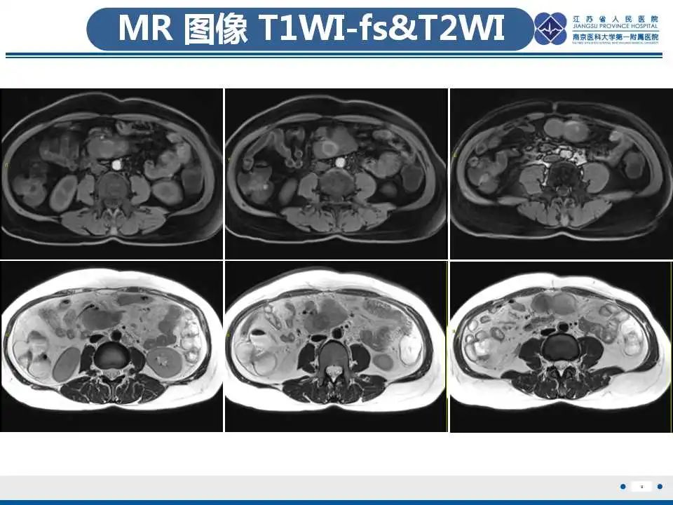 影像PPT - 【PPT】腹腔里的“三明治”—肠系膜淋巴瘤-10