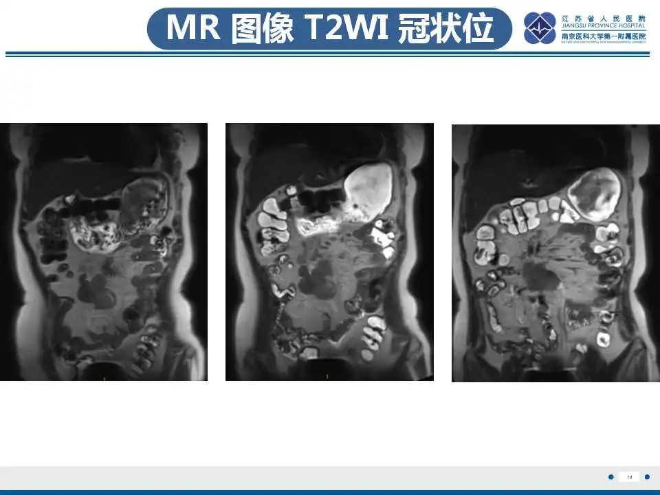 影像PPT - 【PPT】腹腔里的“三明治”—肠系膜淋巴瘤-11