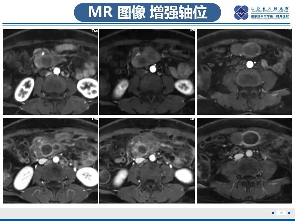 影像PPT - 【PPT】腹腔里的“三明治”—肠系膜淋巴瘤-13