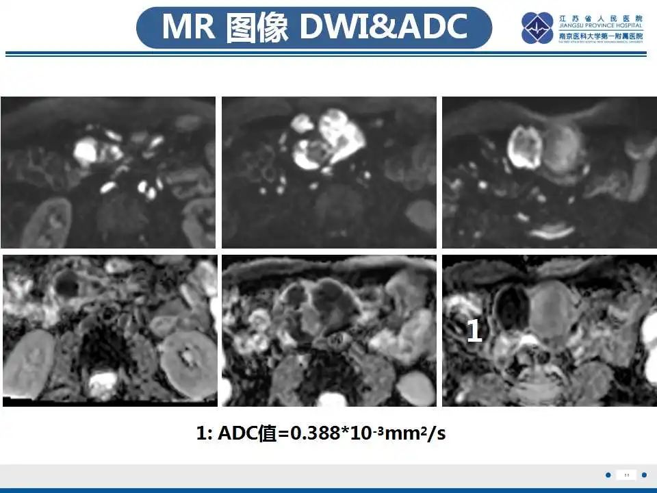 影像PPT - 【PPT】腹腔里的“三明治”—肠系膜淋巴瘤-12